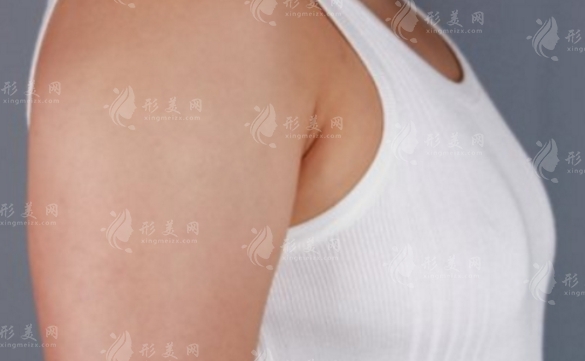 硅膠隆胸取出后可以用脂肪填充嗎？術(shù)后注意事項詳解