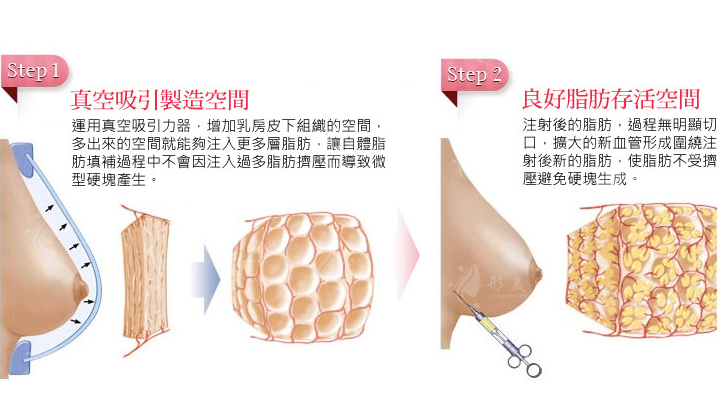自體脂肪填充隆胸