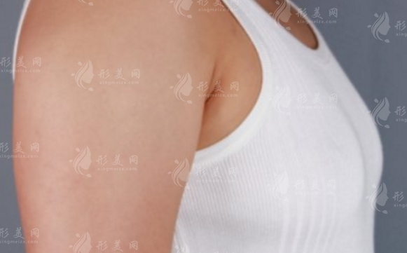 抽脂填胸：價(jià)格解析與手術(shù)前后注意事項(xiàng)