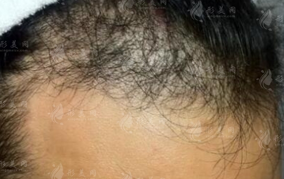 頭發(fā)的種植成活概率與護理技巧