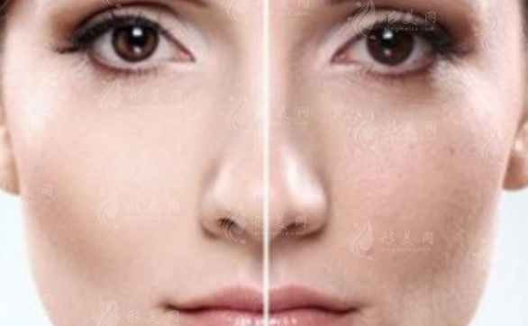 激光祛斑會反彈嗎？術(shù)后應(yīng)注意哪些事項(xiàng)？