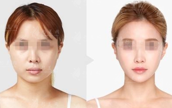 微創(chuàng)面部提升手術(shù)的費(fèi)用及其影響因素分析