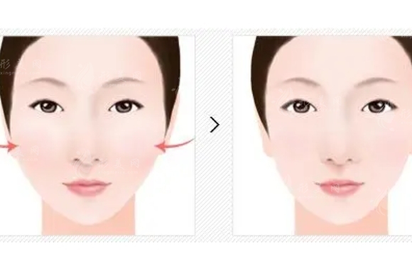 顴骨降低和顴骨內(nèi)推的區(qū)別是什么？手術(shù)后注意哪些事情？