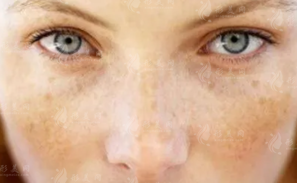 黃褐斑激光幾次能祛除？次數(shù)和哪些因素有關？