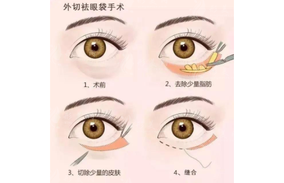 北京聯(lián)合麗格祛眼袋技術(shù)有哪些？