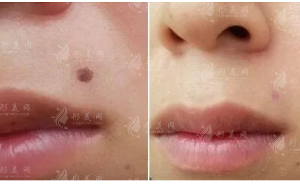 冷凍去痣和激光去痣哪個更好？它們的區(qū)別是什么？