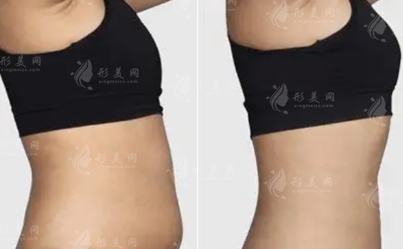 360度吸脂需要多少錢?手術(shù)有哪些風(fēng)險(xiǎn)呢?