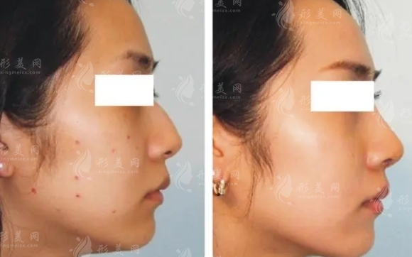 冷凍去痣幾天能脫落及術(shù)后注意事項