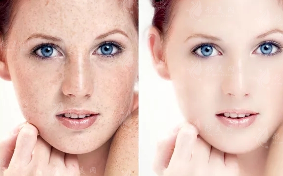 彩光嫩膚祛斑要做幾次?一共需要多少錢? 彩光嫩膚祛斑要做幾次?一共需要多少錢?