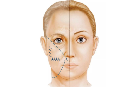 電波拉皮:作用與副作用的深入解析 電波拉皮:作用與副作用的深入解析