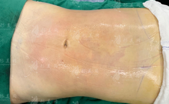 做腹部吸脂術(shù)的方法，及術(shù)后注意事項(xiàng)都有什么呢？