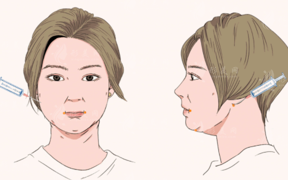 上海九院做面部吸脂技術(shù)如何？口碑醫(yī)生、整形問答、附價(jià)格表