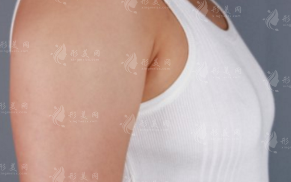 自體脂肪隆胸與假體隆胸:兩者之間的區(qū)別 自體脂肪隆胸與假體隆胸:兩者之間的區(qū)別