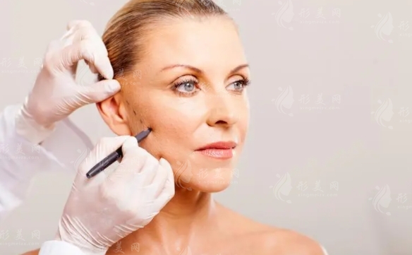 電波拉皮可以去除眼袋嗎？有效嗎？