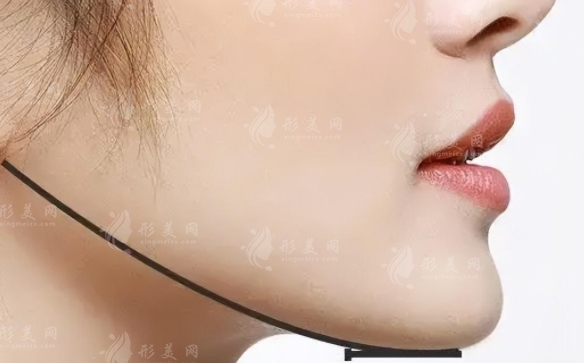 下頜角截骨術(shù)：適合人群與年齡段的深度解析