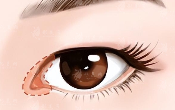 如何縮短開眼角后疤痕消失的時間