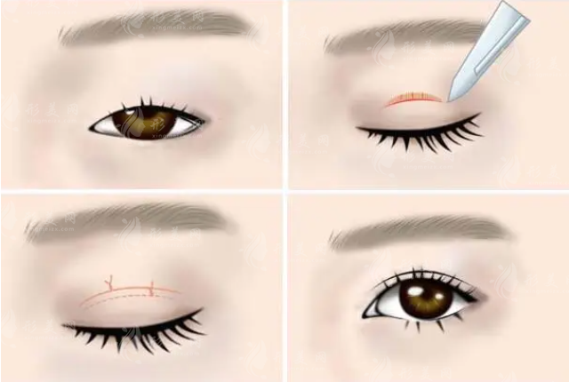 上海第六人民醫(yī)院整形科雙眼皮案例