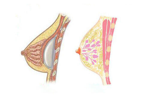 上海長海醫(yī)院隆胸案例