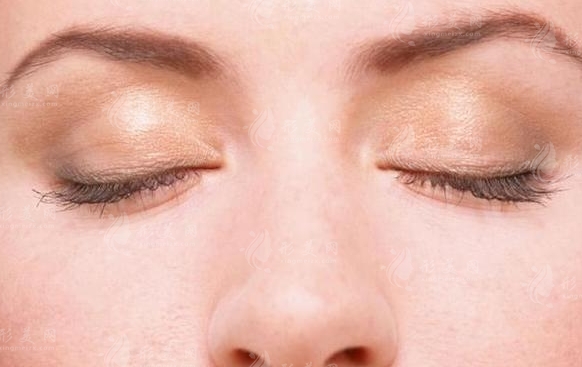 內(nèi)切眼袋手術(shù)后恢復(fù)時(shí)間詳解
