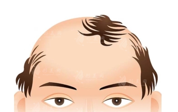 毛發(fā)移植方法及其步驟詳解