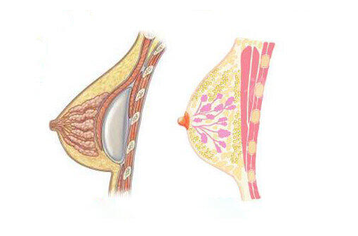 南京美萊夏建軍醫(yī)生隆胸價格多少+隆胸優(yōu)勢+手術(shù)預(yù)約公布