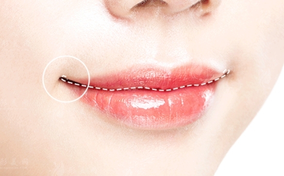 微笑唇手術及其拆線時間解析