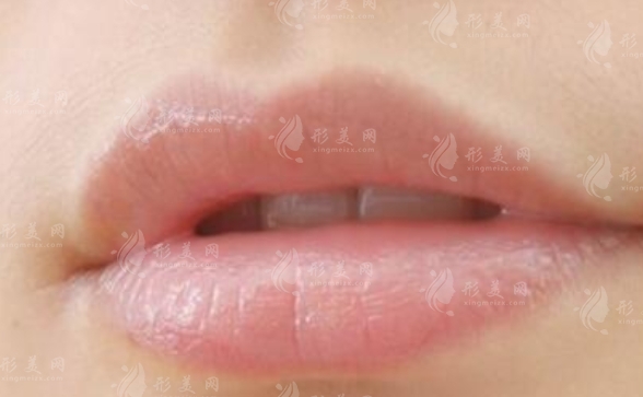 唇部脫毛多久做一次及禁忌人群探討