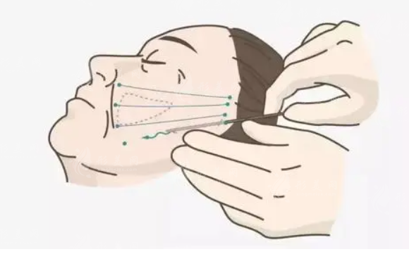 北京八大處做拉皮除皺多少錢？口碑專家、案例、價(jià)格表更新