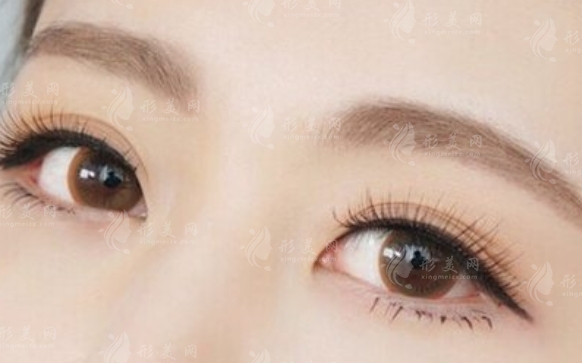 常見的切眉手術(shù)方法及其適用人群 常見的切眉手術(shù)方法及其適用人群