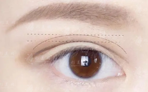 雙眼皮手術(shù)失敗幾率與修復(fù)方法探討 雙眼皮手術(shù)失敗幾率與修復(fù)方法探討