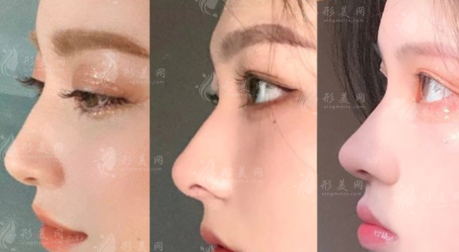 范榮杰醫(yī)生做鼻子技術(shù)怎么樣？