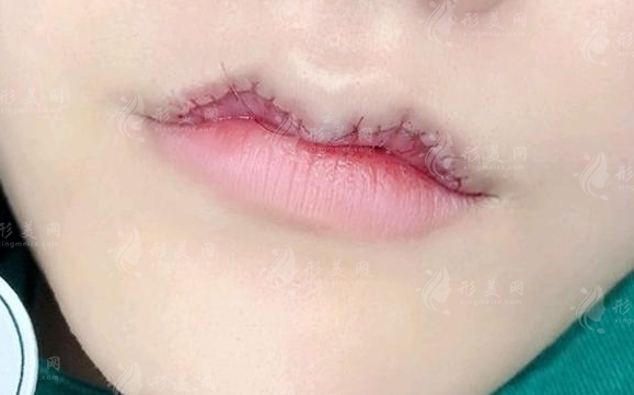 微笑唇手術(shù)后的恢復(fù)之旅
