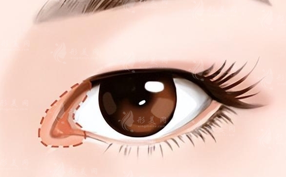 常見的開眼角方法及其注意事項