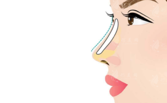 北京大學(xué)第一醫(yī)院整形隆鼻多少錢？醫(yī)生介紹、案例反饋、價格表