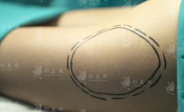 過度抽脂的安全性及吸脂手術(shù)引起的出血問題探討