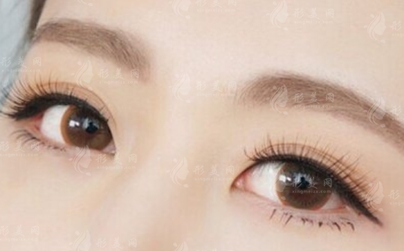 切眉的優(yōu)點(diǎn)及其對于去除魚尾紋的效果分析 切眉的優(yōu)點(diǎn)及其對于去除魚尾紋的效果分析