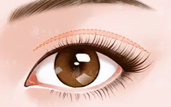 北京八大處割雙眼皮價(jià)格多少？?jī)?yōu)勢(shì)有哪些？醫(yī)生介紹、價(jià)格表