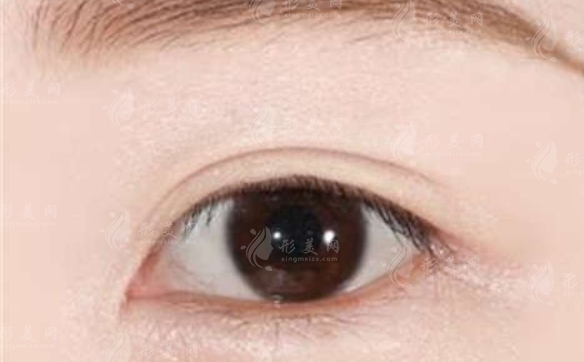 內(nèi)眼角手術(shù)后會回縮嗎？開內(nèi)眼角手術(shù)的風(fēng)險又有哪些？