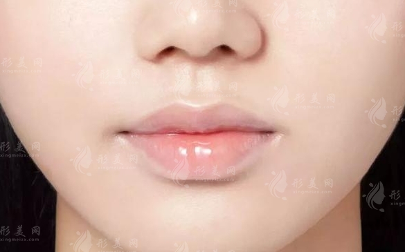 唇部提升手術：解析與適用人群探討