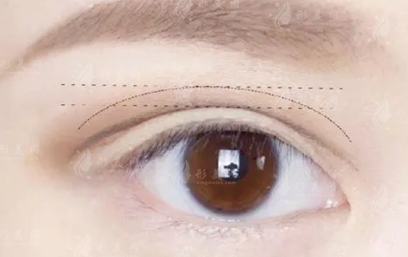 割雙眼皮與開(kāi)內(nèi)眼角：能否同時(shí)進(jìn)行的美麗選擇