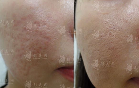 點(diǎn)陣激光可以去除痘坑嗎，效果怎么樣