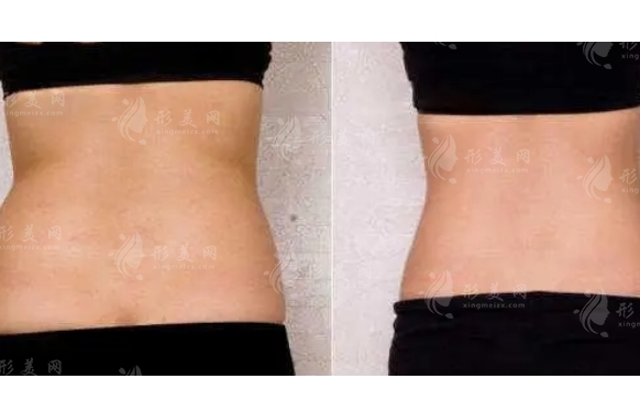 抽脂術(shù)后皮膚會(huì)因?yàn)橹玖魇ё兊盟沙趩?