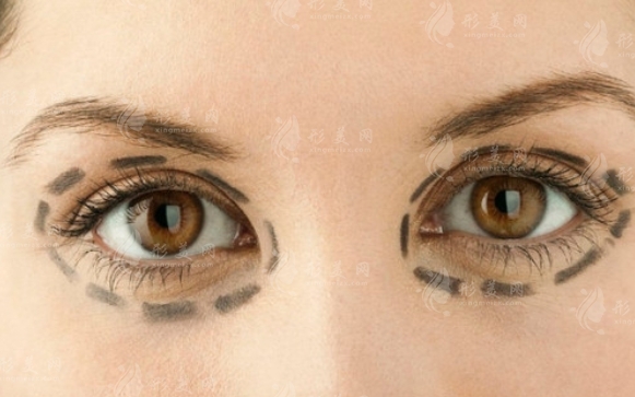 外眼角手術(shù)風(fēng)險解析：因素與影響