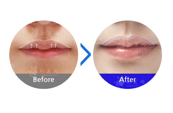 上海九院唇部整形怎么樣？唇腭裂，豐唇收費價格，熱門醫(yī)生提前挑選！