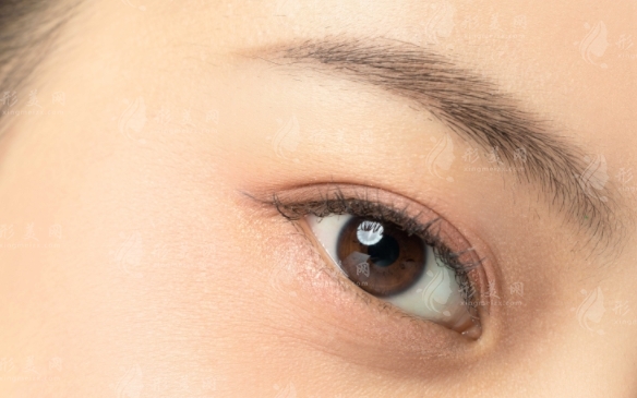 腫眼泡吸脂后會反彈嗎？如何避免反彈