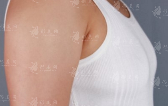 硅膠隆胸:美麗與哺乳的雙重考量 硅膠隆胸:美麗與哺乳的雙重考量