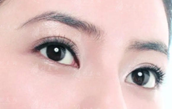 切眉手術(shù)后效果不自然:應(yīng)對(duì)策略與修復(fù)之道 切眉手術(shù)后效果不自然:應(yīng)對(duì)策略與修復(fù)之道