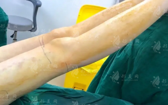 腿部吸脂的特點(diǎn)及其對(duì)正常行走的影響