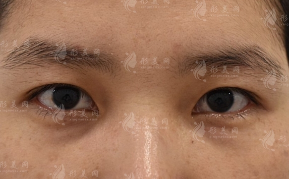 影響自體脂肪填充淚溝維持時(shí)間的因素分析