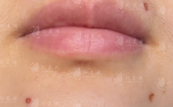 激光去痣后出現(xiàn)凹坑：應(yīng)對策略與解決方案